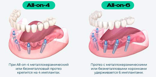 All-on-4 и All-on-6 Савёловская